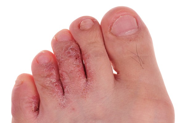 foot-problems-athletes-foot