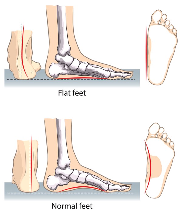 foot-problems-flat-feet