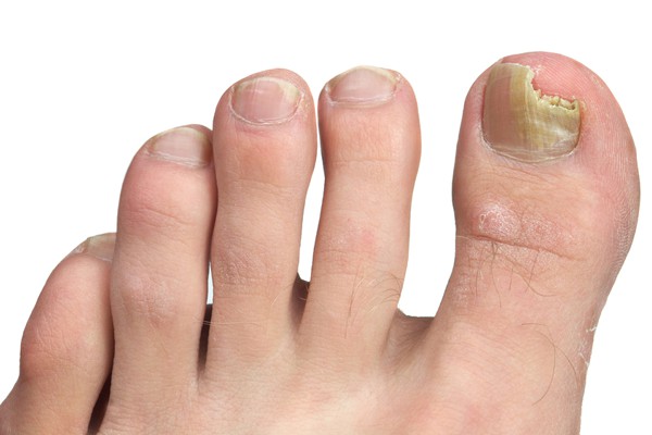 foot-problems-fungus-toenails