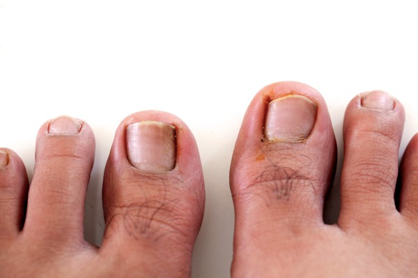 foot-problems-ingrown-toenails