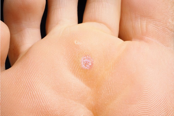 foot-problems-warts.jpg
