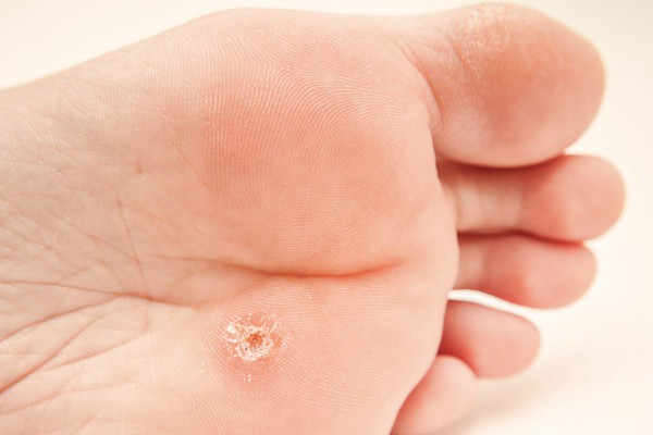 foot-problems-warts2